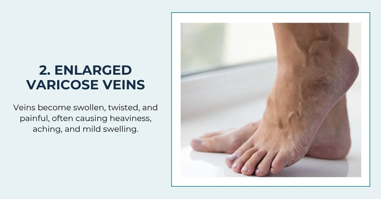 Twisted, bulging varicose veins on the foot.