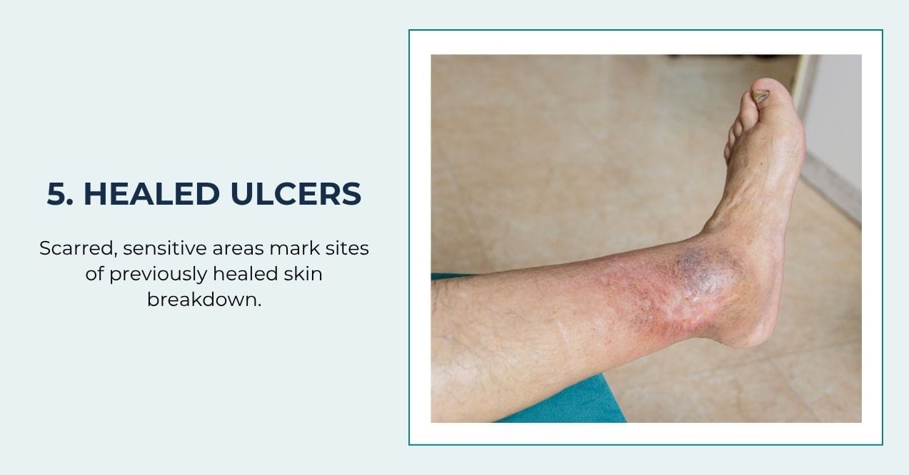 Scarred skin on the lower leg from healed ulcers.