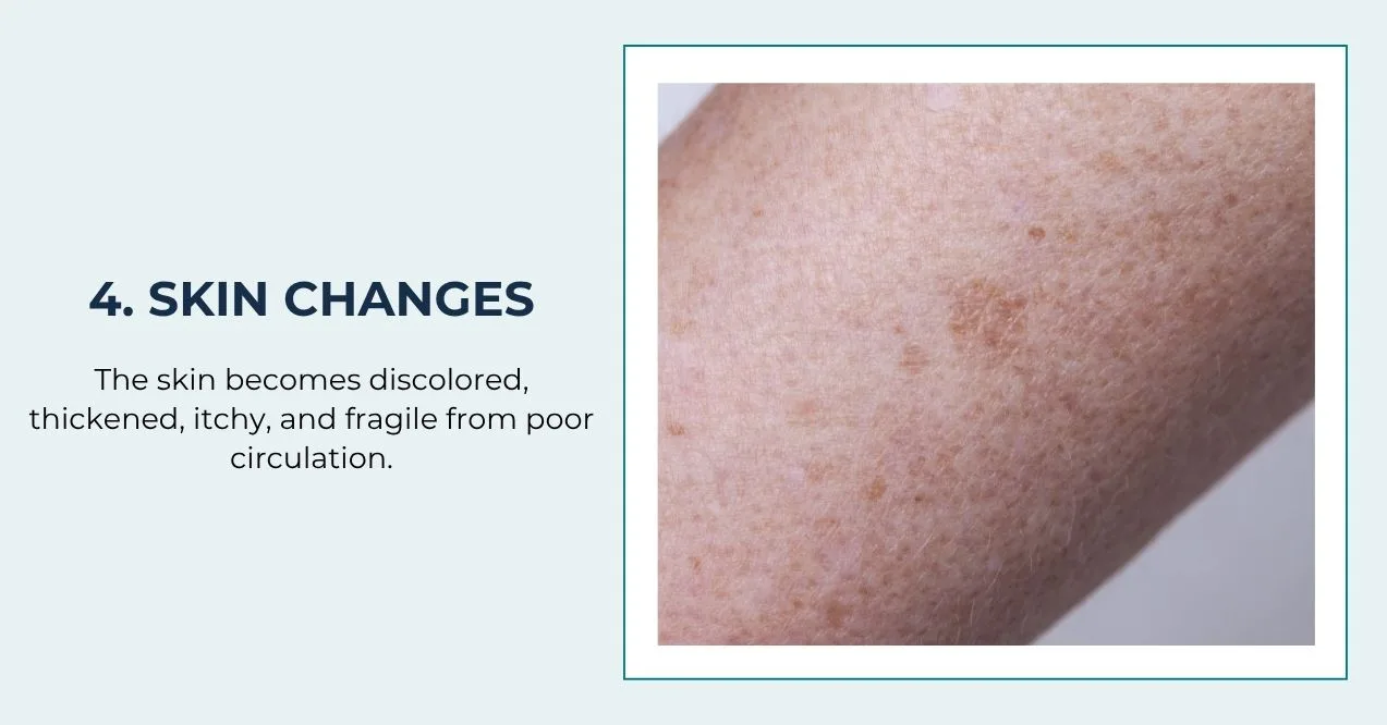 Discolored, thickened, and itchy skin on the leg.