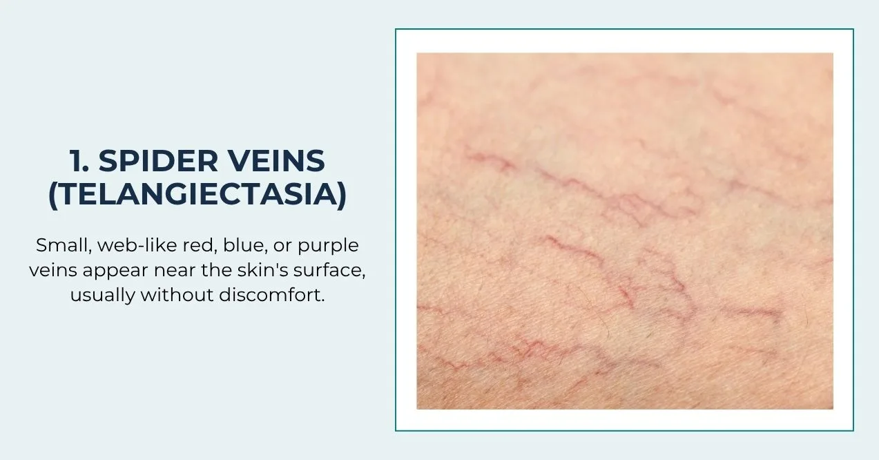 Red spider veins visible near the skin’s surface.