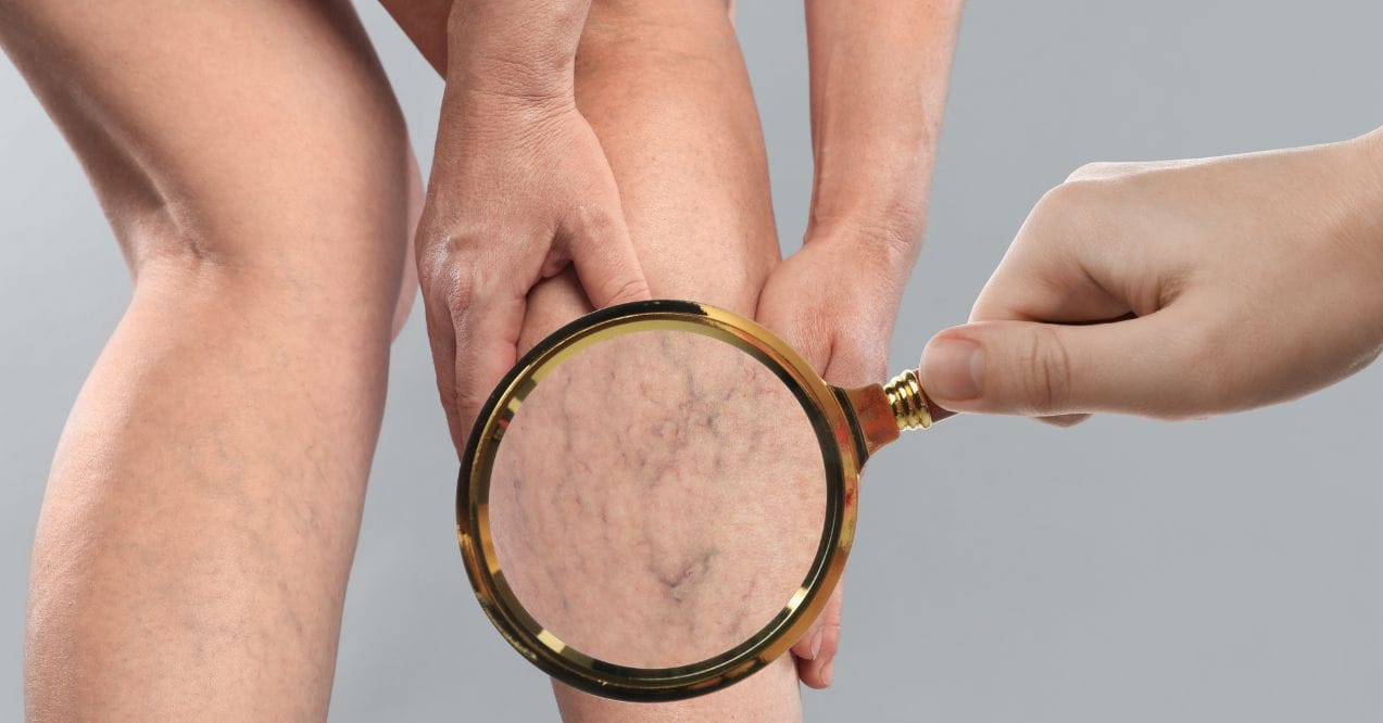 Close-up of spider veins on a leg under a magnifying glass resembling the stages of varicose veins.