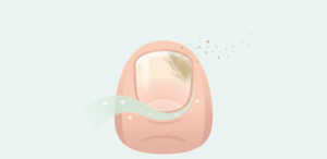 How to Know if Toenail Fungus is Dying