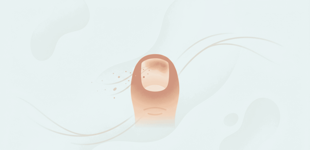 Subungual Onychomycosis