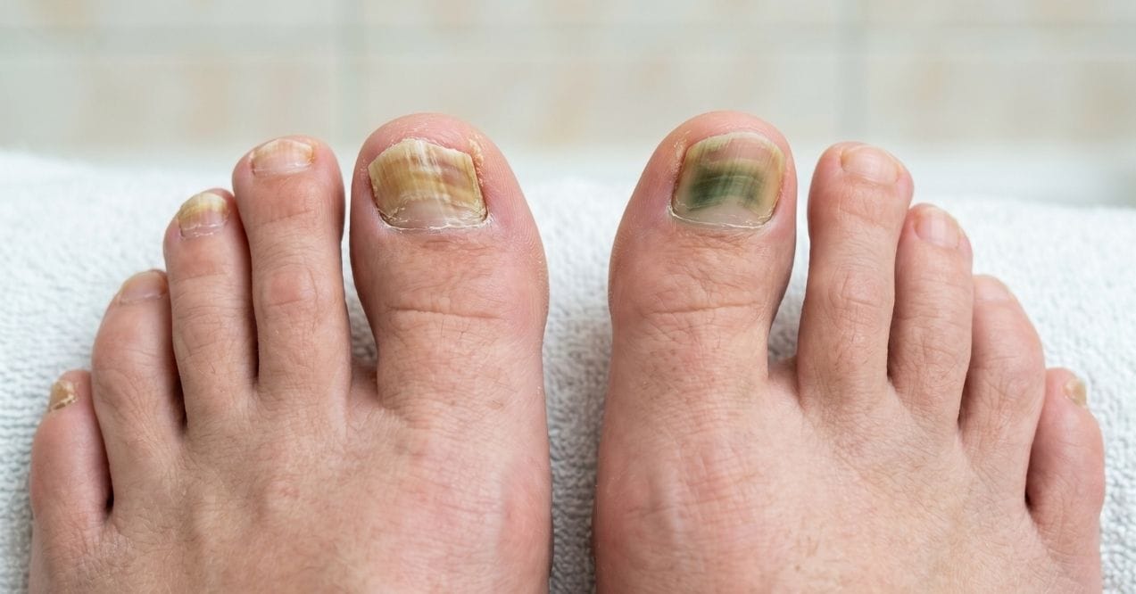 Nail mold vs. fungus