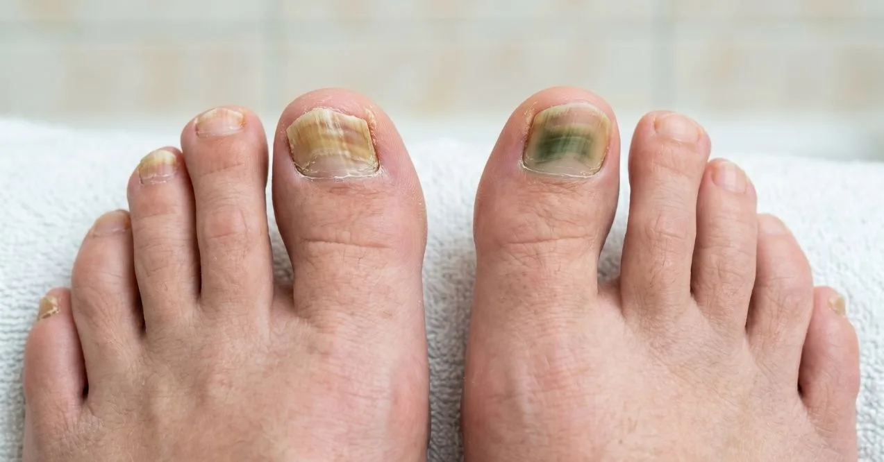 Nail mold vs. fungus