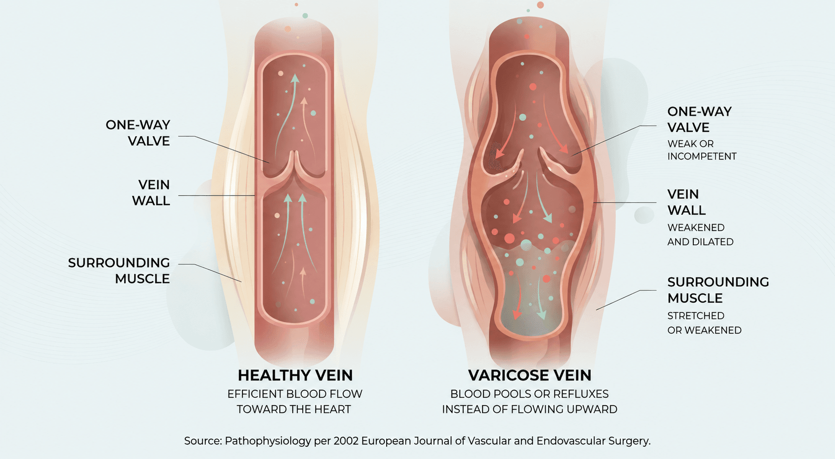 Diagram comparing a healthy vein with working valves to a varicose vein with weak valves and pooled blood