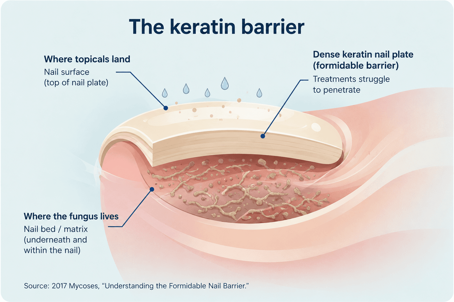 Diagram of nail's keratin barrier: topicals land on the surface while fungus lives underneath in the nail bed/matrix