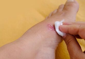 Applying cotton to a foot wound to treat weeping legs.